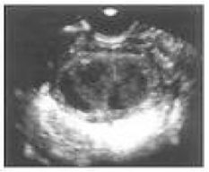 Teratoma Ov rico Laparoscopia Teratoma Ov rico Laparoscopia