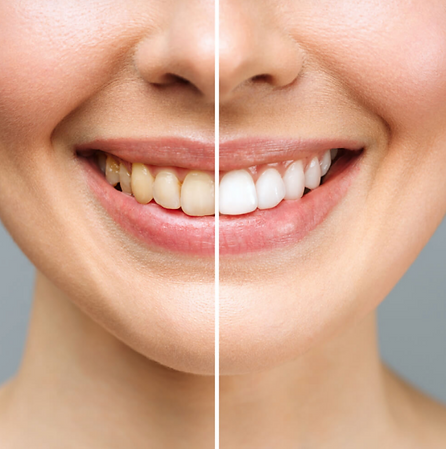 sbiancamento denti studio medico dentistico castello.png