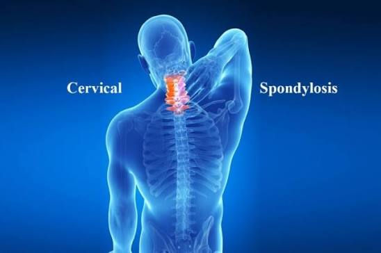 Cervical & Lumbar Spondylosis.jpg