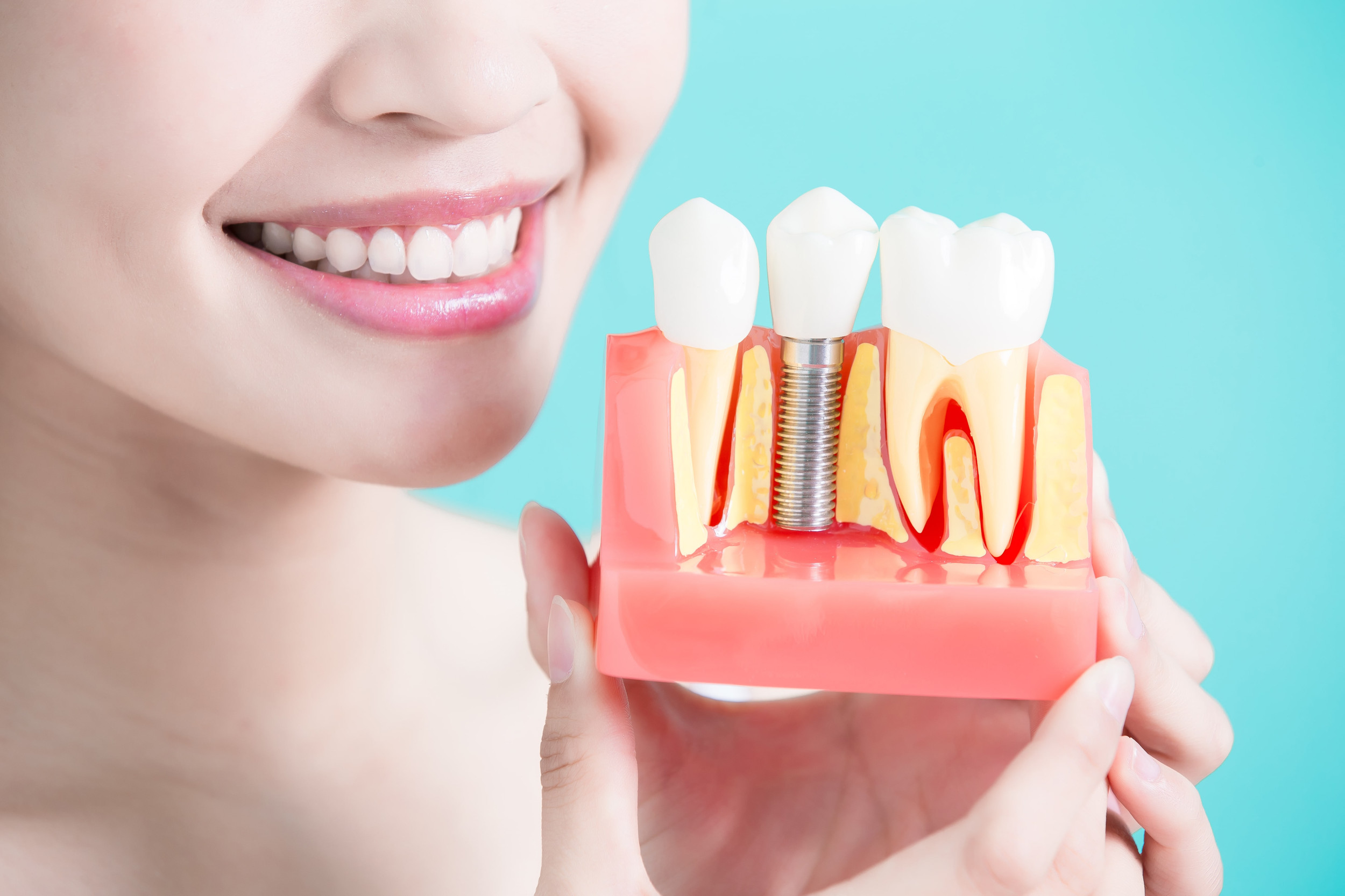 Dental Implant Pristine Dental Ahmedabad Best Dental Clinic