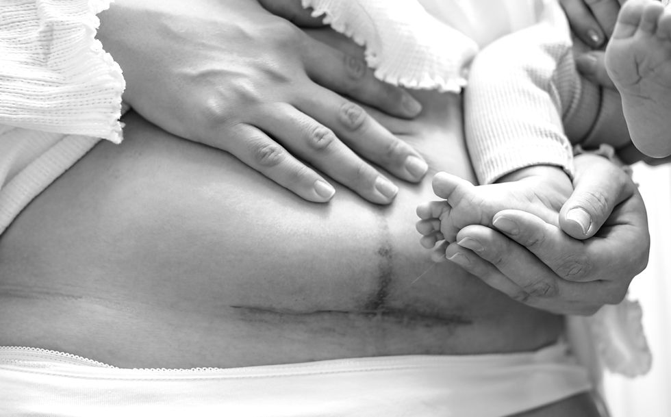 Post C Section Physical Therapy