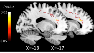 Mindfulness Can Literally Change Your Brain