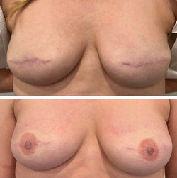 Bilateral 3D Areola Tattoo