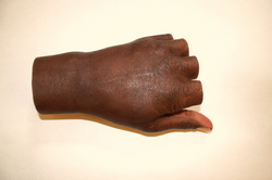 Partial Hand for thumb amputation