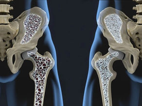 Osteoporosis