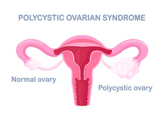 Is There Any Relation Between PCOS And Breast Health?