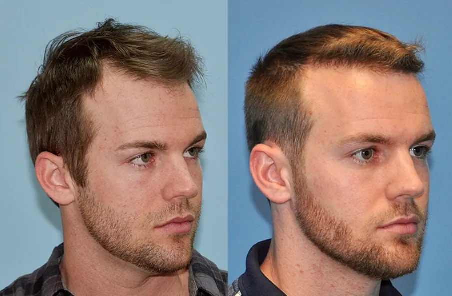 Why Consider Hair Replacement as a Young Man?