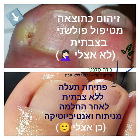 ציפורן חודרנית 2