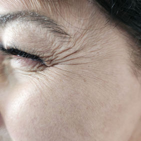 טיפול בוטוקס לפני