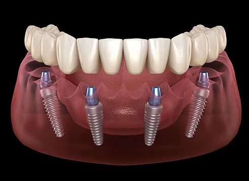 Full Mouth Dental Implants in Costa Rica | All On 4 dental implants