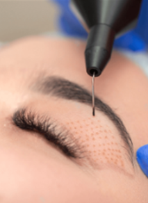 Fibroblast Plasma Skin Tightening.png