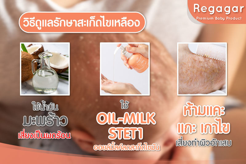 วิธีดูแลรักษาสะเก็ดไขเหลือง