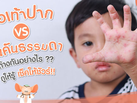 โรคมือเท้าปาก