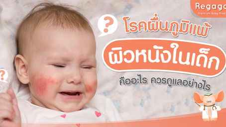 โรคผื่นภูมิแพ้ผิวหนัง ในเด็ก คืออะไร ควรดูแลอย่างไร