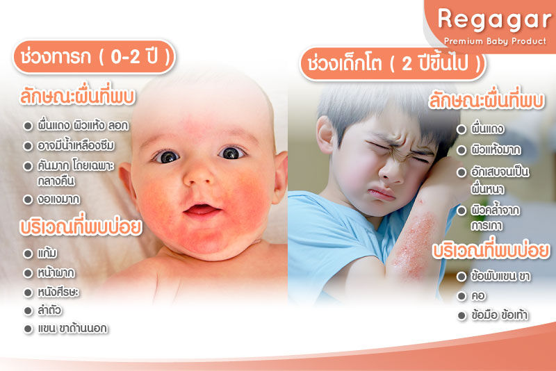 ผื่นภูมิแพ้ผิวหนังตามช่วงวัย