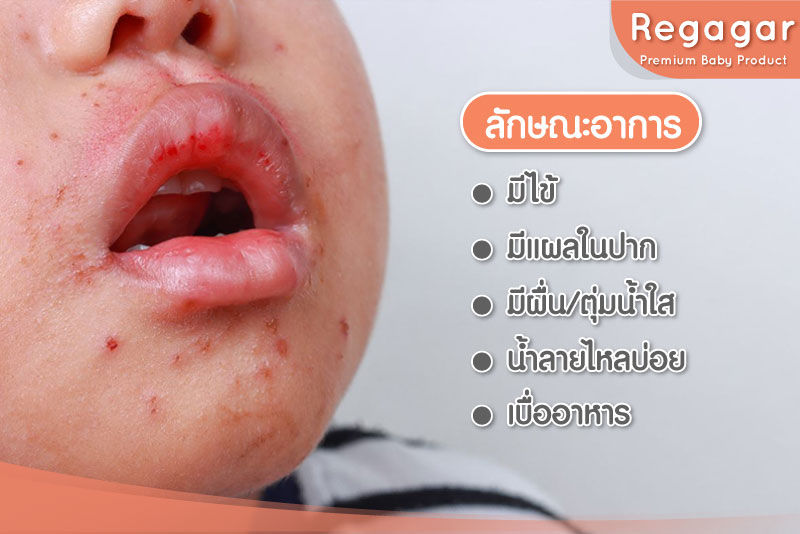 อาการ มือเท้าปาก
