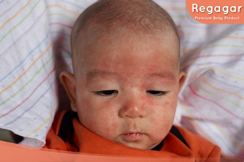 ผื่นเด็กทารก