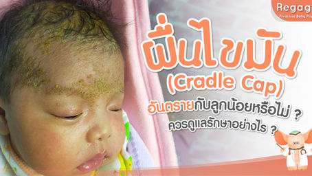 ผื่นไขมัน ( Cradle Cap ) อันตรายกับลูกน้อยหรือไม่ ควรดูแลรักษาอย่างไร