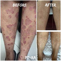 7 Years of Chronic Skin Psoriasis Resolved