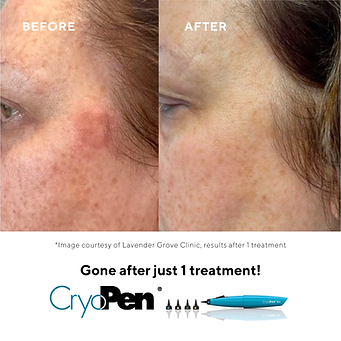 CryoPen before and after picture