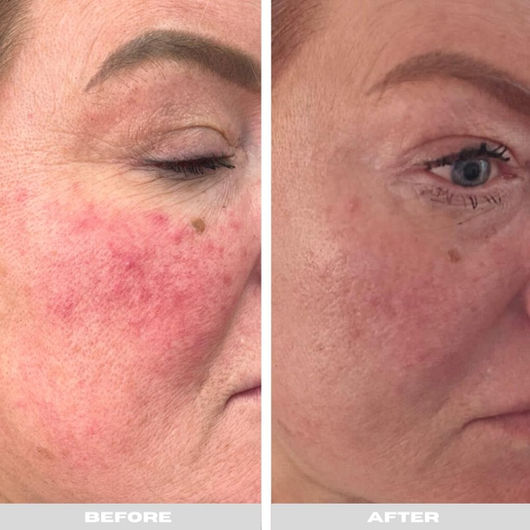 Before and After skin treatment on a woman's face, visible improvement after PRP.