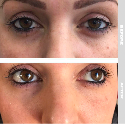 Comparison of eyes before and after PRP treatment.