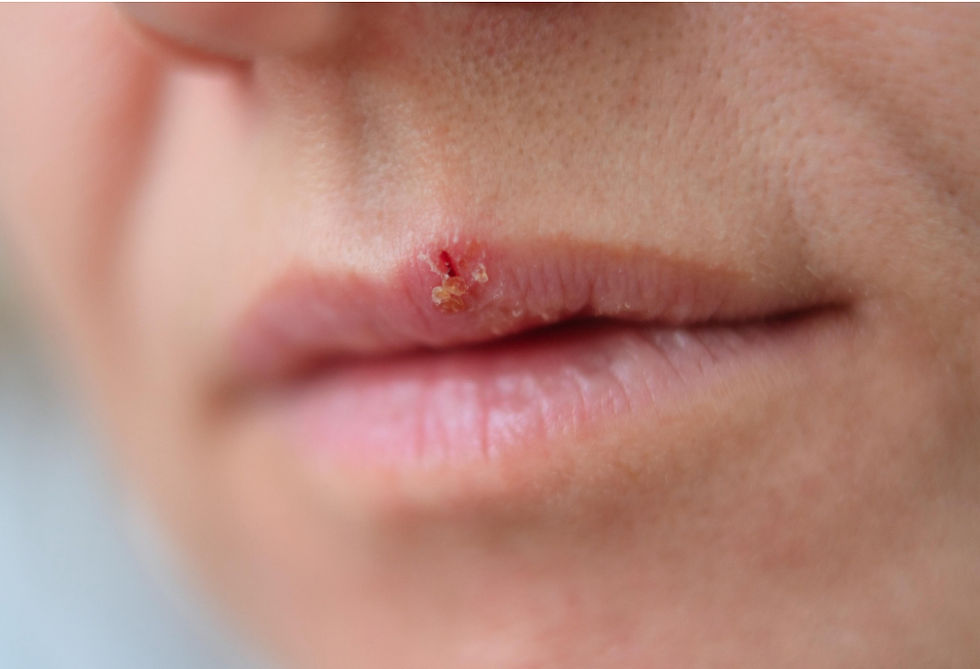 COLD SORE : SYMPTOMS, CAUSES AND TREATMENT
