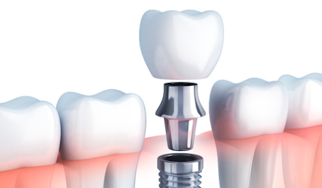 IMPLANTES DENTALES