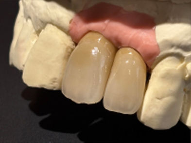 Optimale Implantatversorgung 3