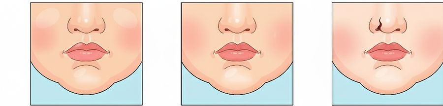 新生児三口 原因 遺伝子.png