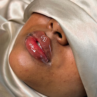 Subtle yet voluminous lip filler results at Ministry of Faces in Leeds.