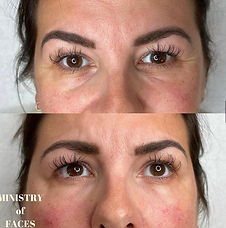 Precision tear trough filler Leeds enhancing hydration and reducing tired-looking eyes.