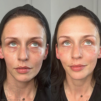 Tear trough filler Leeds correcting deep-set hollows for a smoother, more awake look.