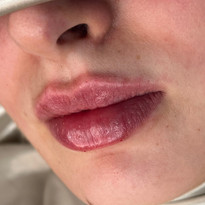 Client review of their lip filler experience at a top Leeds aesthetics clinic.