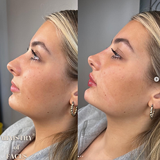Client showing natural, fuller lips after lip filler treatment