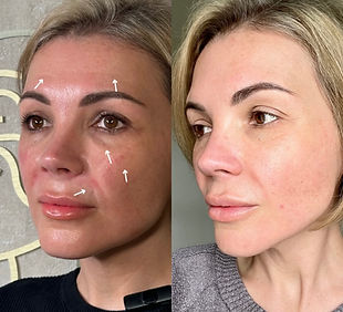 Before and after 6-area Botox and filler package in Leeds with natural, rejuvenated results by Ministry of Faces.