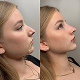 chin lemon bottle fat dissolving 7 Things You've Got to Know About Lemon Bottle! main image 0