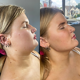 lemon bottle fat dissolving injections before and after Lemon Bottle Fat Dissolving main image 1