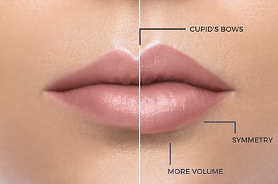 Leppeområder for behandling