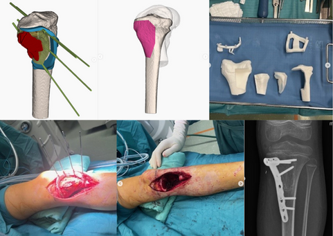 This Friday, we’re highlighting a great example of an allograft reconstruction of the proximal tibia.