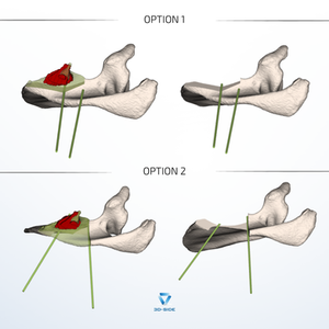 Option 1 vs Option 2 scapular spine resection planning