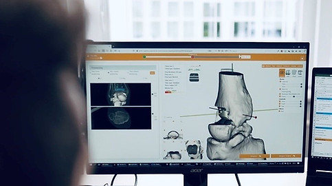 Ankle Arthroplasty pre-opplanning