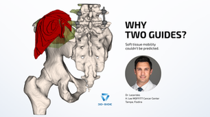3D render of a pelvic tumor resection planning with patient-specific cutting guides, case by Dr. Alexander Lazarides at H. Lee Moffitt Cancer Center