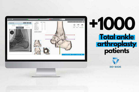 +1000 patients treated with total ankle arthroplasty!
