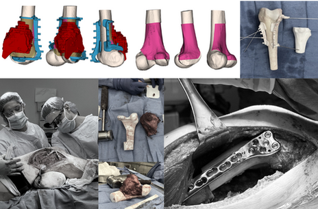Bone Tumor Resection with Allograft Reconstruction in the Distal Femur