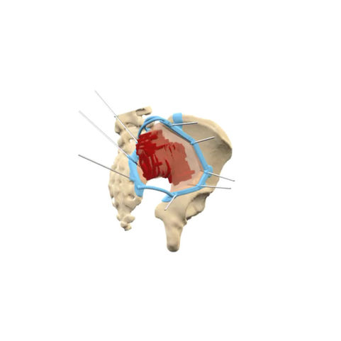 Another insightful case from the field of bone tumor surgery