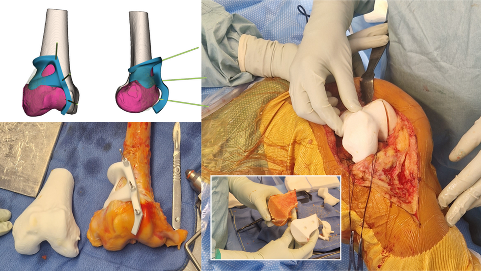 Successful Femoral Tumor Resection with Patient Specific Guide and