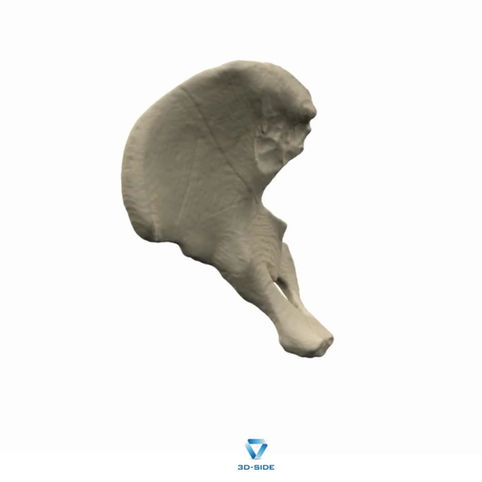 Corrective Osteotomy for Hip Dysplasia: A PAO Case Guided by 3D Planning