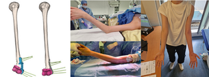 Flexion Contracture Resolved: A Successful Humerus Realignment