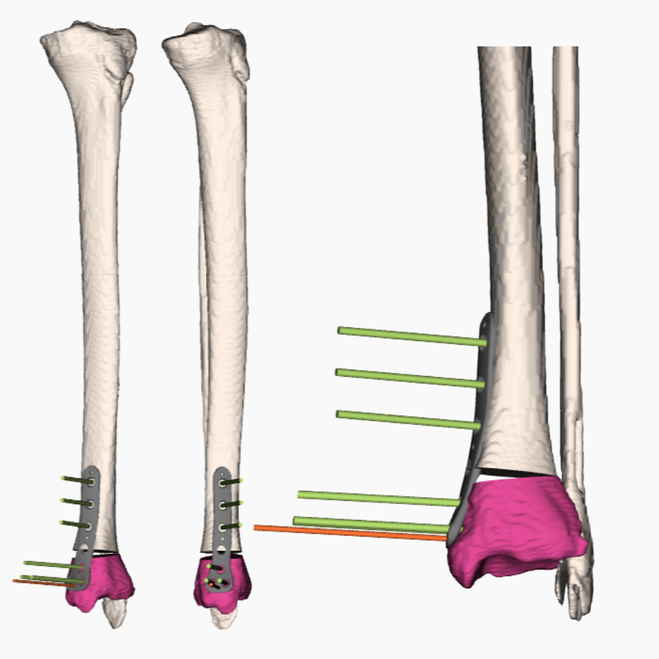 3D postoperative view of the distal tibial osteotomy showing the corrected alignment and fixation plate in position after 3D preoperative planning.